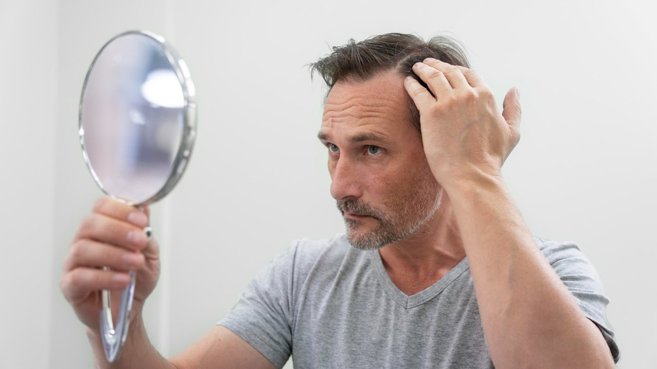 causas da alopecia e os tratamentos para alopecia em homens