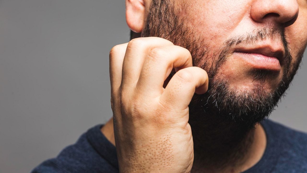 Barba com Caspa e Coceira dicas para evitar