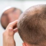 Calvície masculina tem tratamento? Descubra as principais soluções